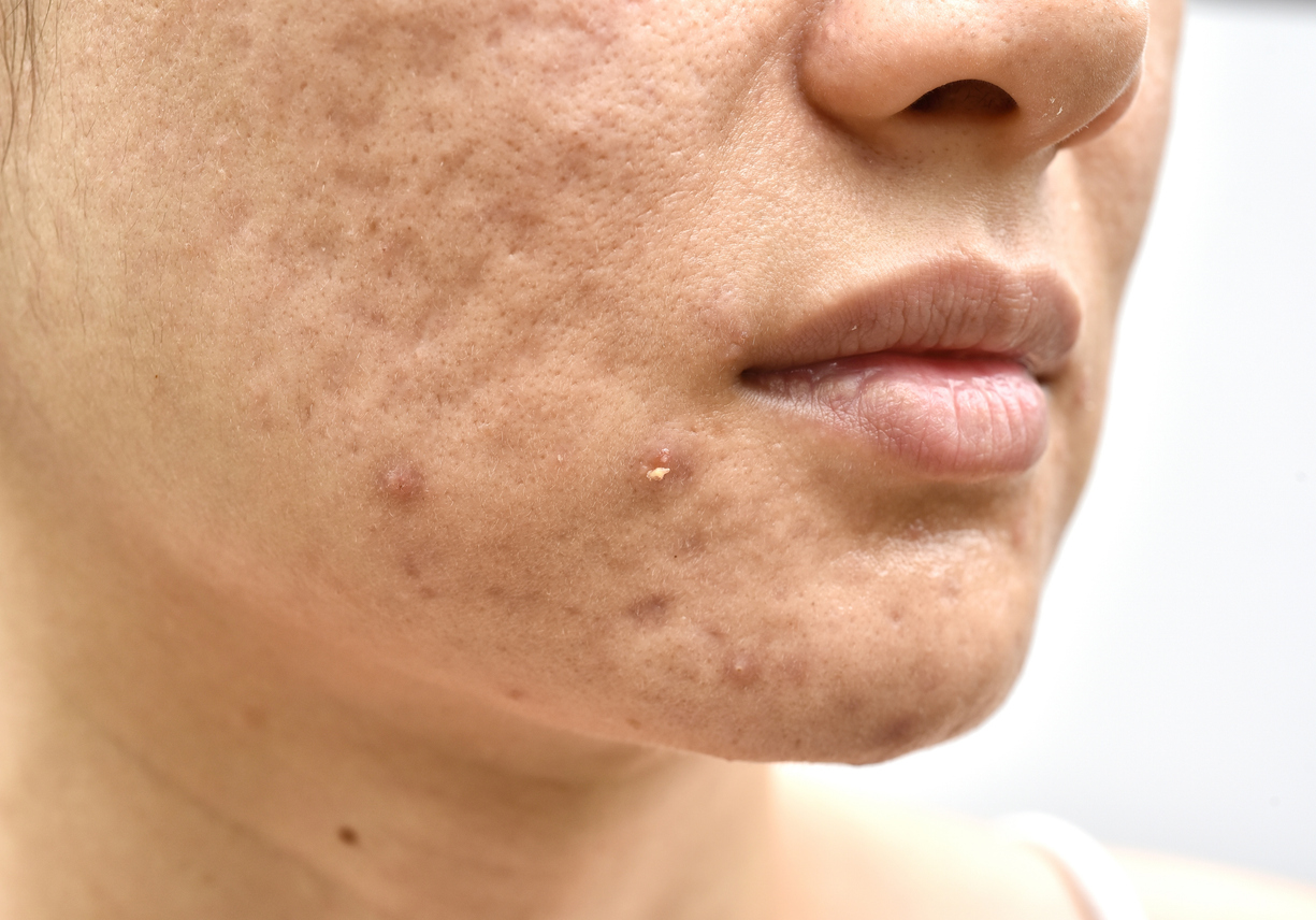 Acne Scars