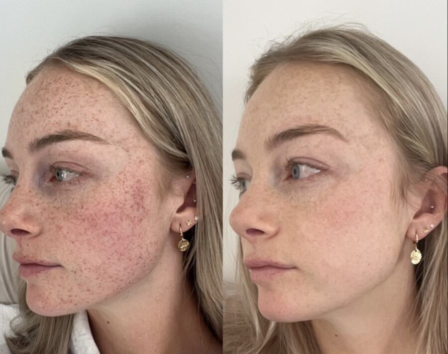 Pigmentation and age spots before and after dermatology treatment.