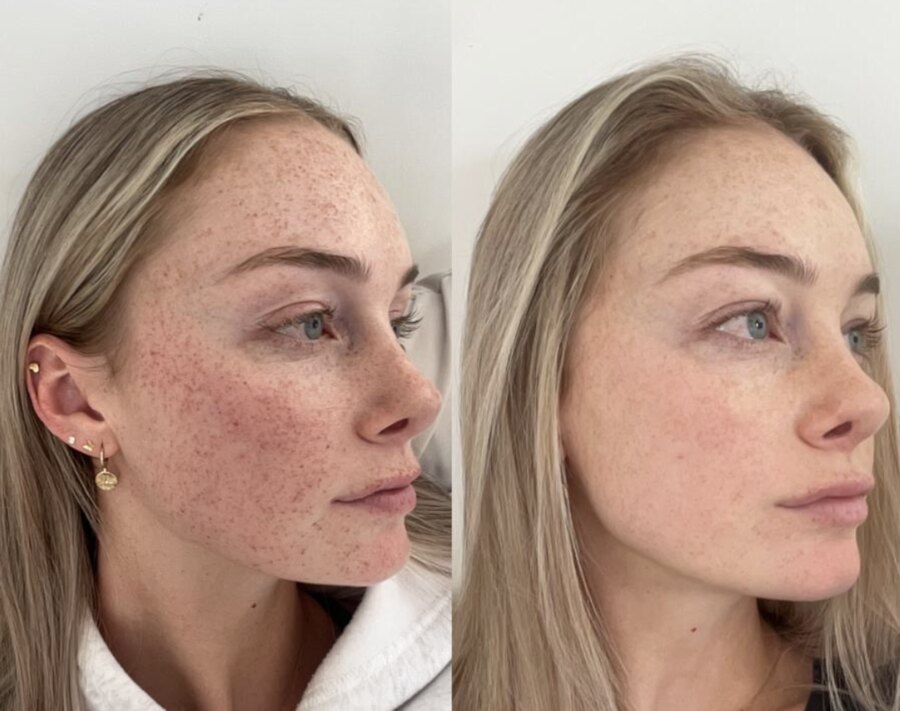 Freckles and sun-related pigmentation before and after dermatology treatment.