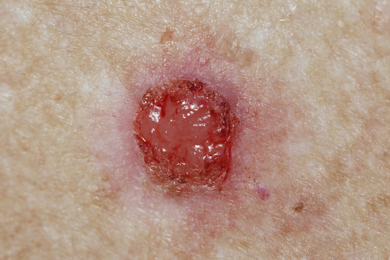 Basal Cell Carcinoma