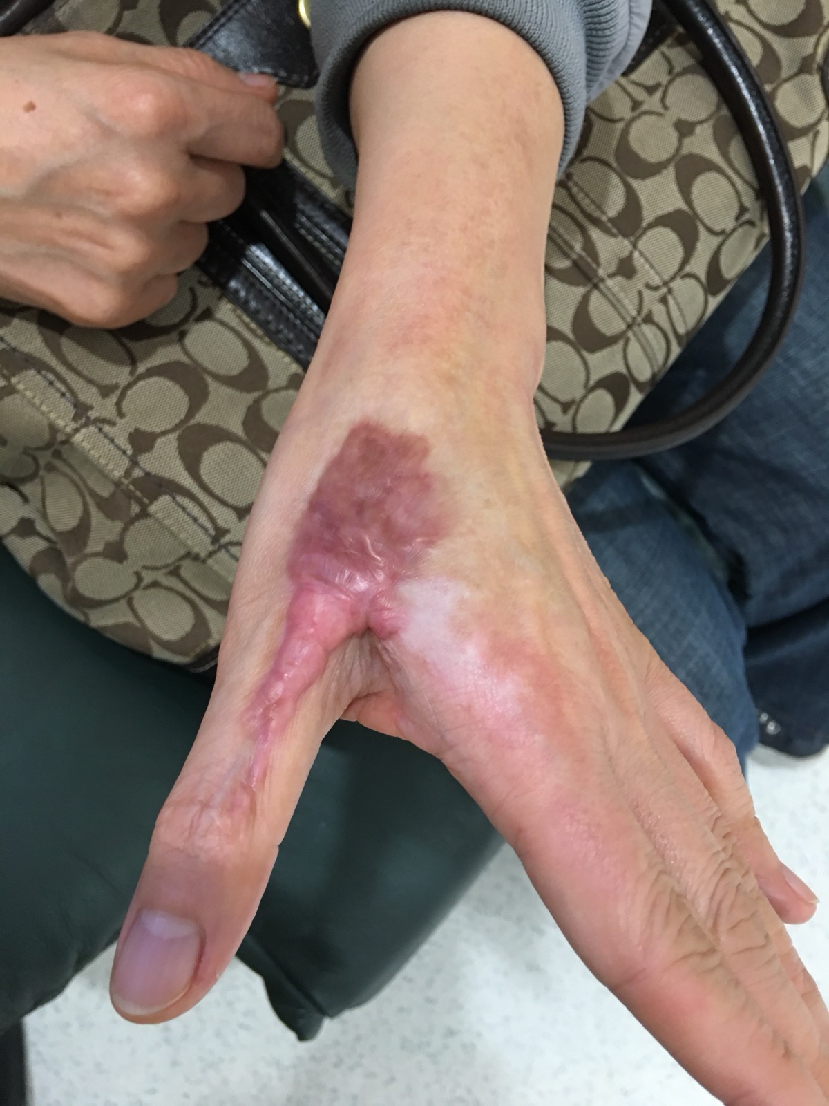 Contracture Scars