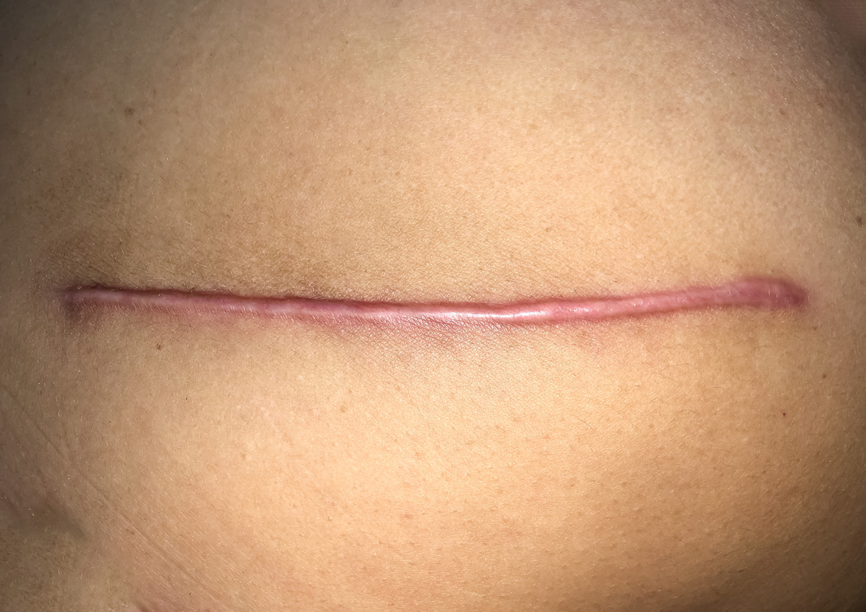 Hypertrophic Scars