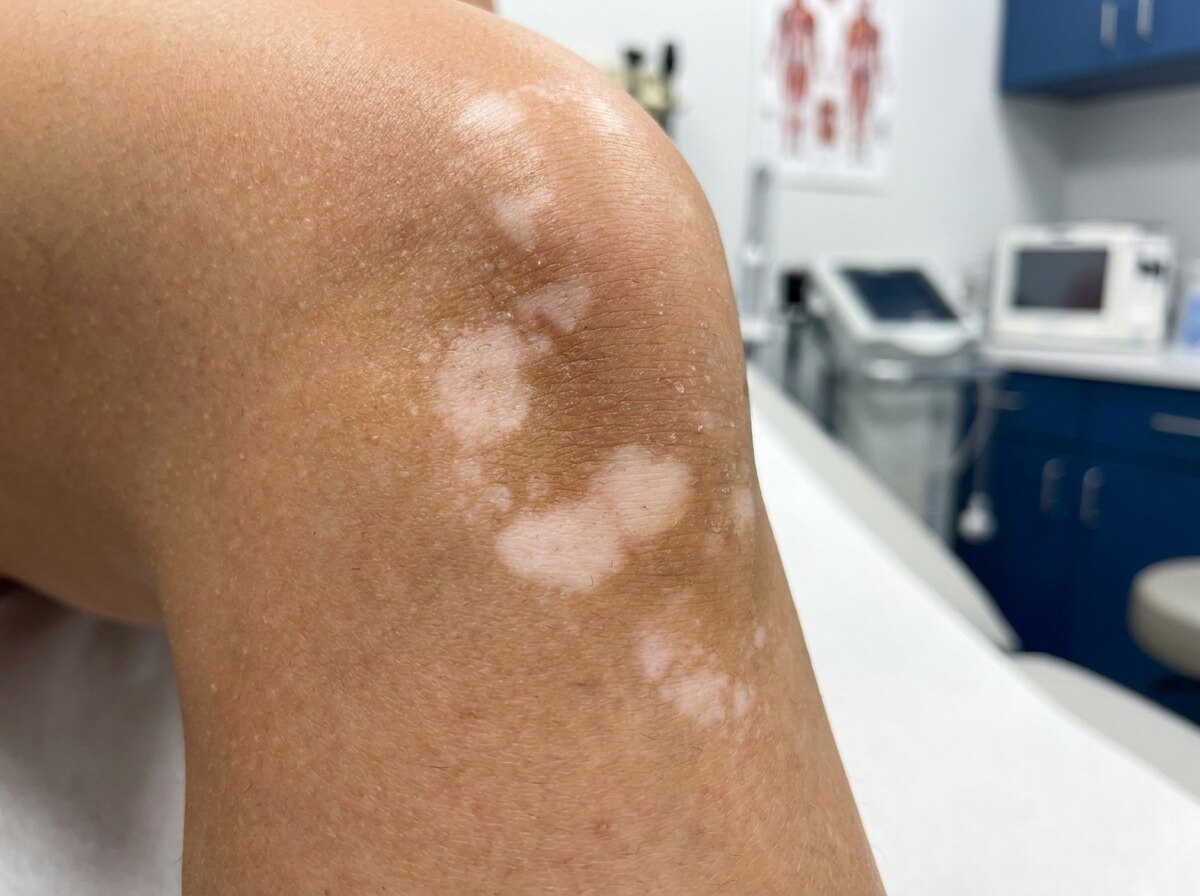 Hypopigmentation