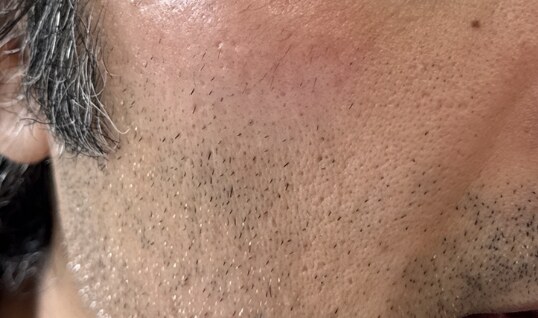Melasma after laser and pigment-modifying treatment — the pigmentation has substantially cleared.