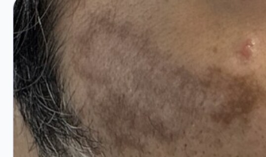 Melasma before treatment — patchy brown hyperpigmentation across the cheek.