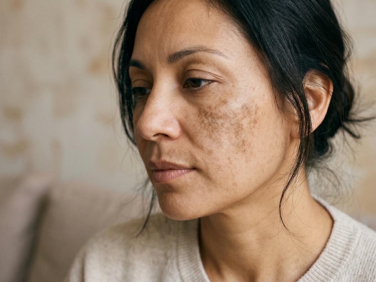Melasma (Hormonal pigmentation/chloasma)