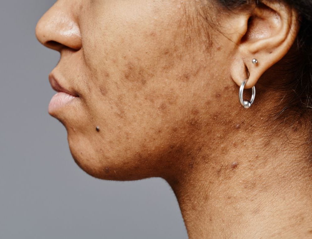 Post-Inflammatory Hyperpigmentation
