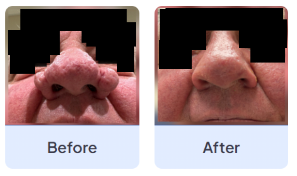 Rhinophyma before and after laser treatment — the thickened, distorted nasal skin is reduced and the natural nasal contour restored.
