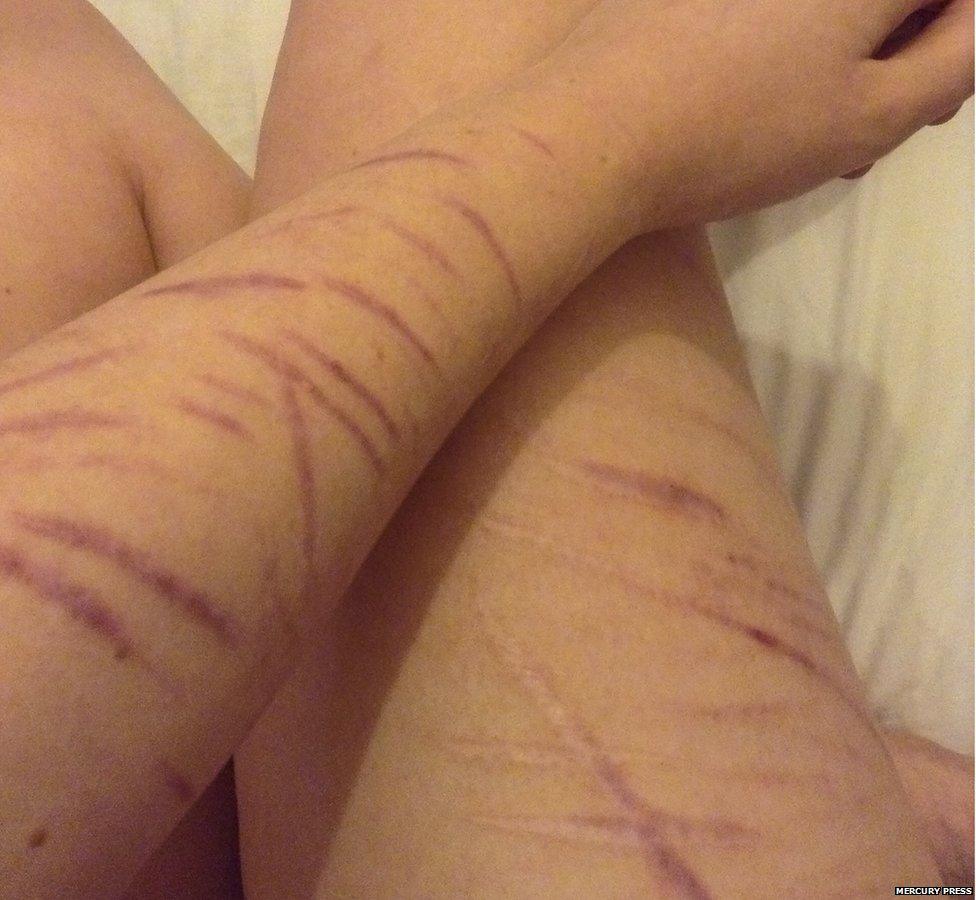 Self-Harm Scars