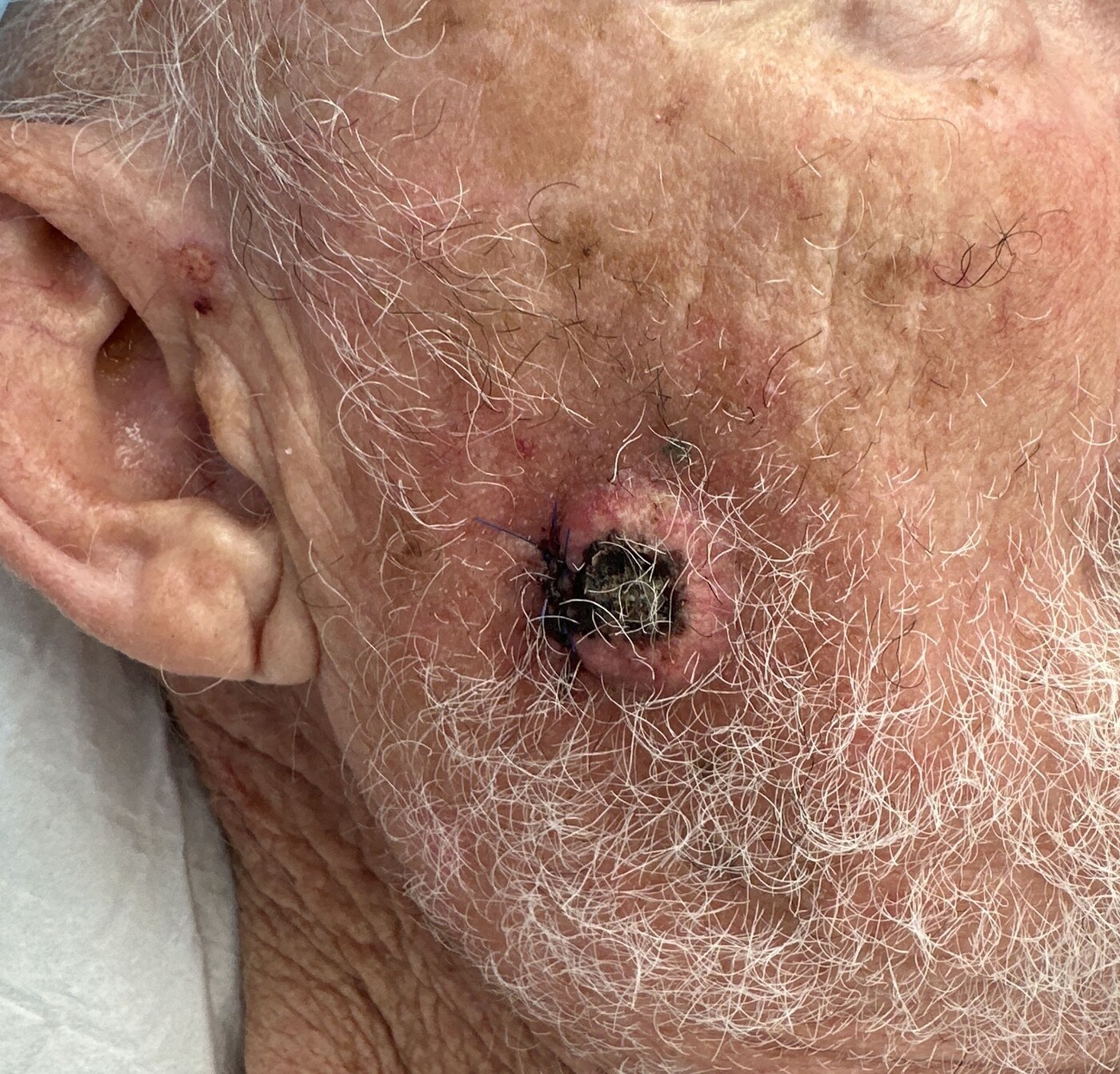 Squamous Cell Carcinoma