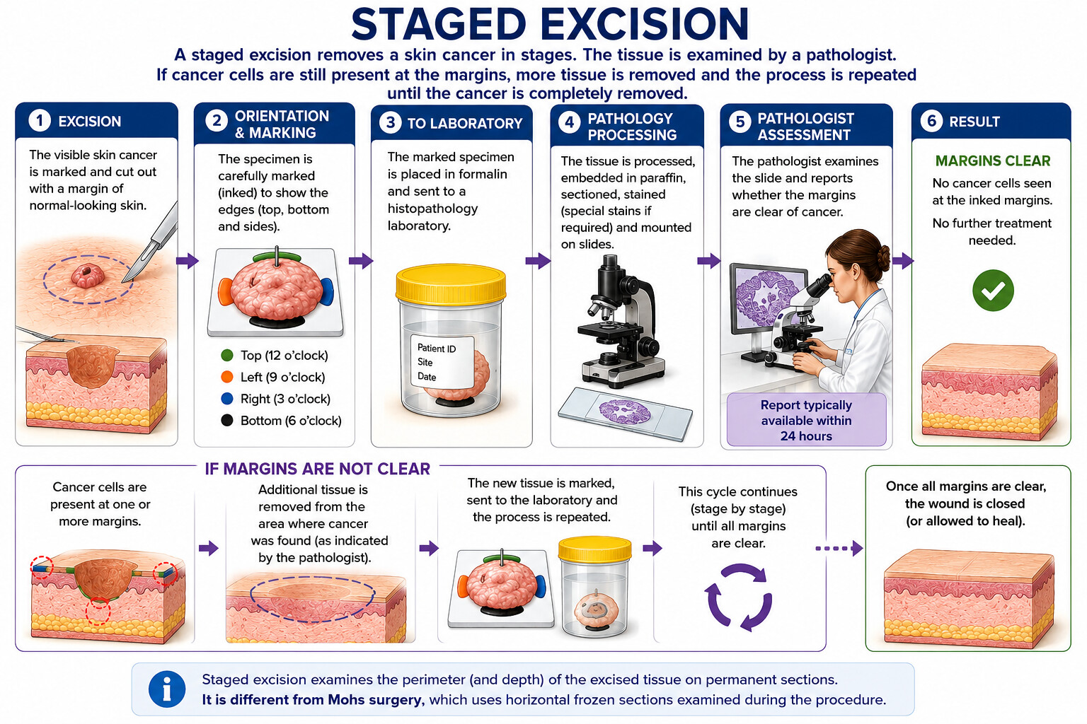 Staged excision step-by-step diagram — the visible skin cancer is excised with a margin, the specimen is oriented and sent to the laboratory, processed and assessed by a pathologist; if margins are not clear the involved area is re-excised and the cycle repeats until all margins are clear and the wound is closed.