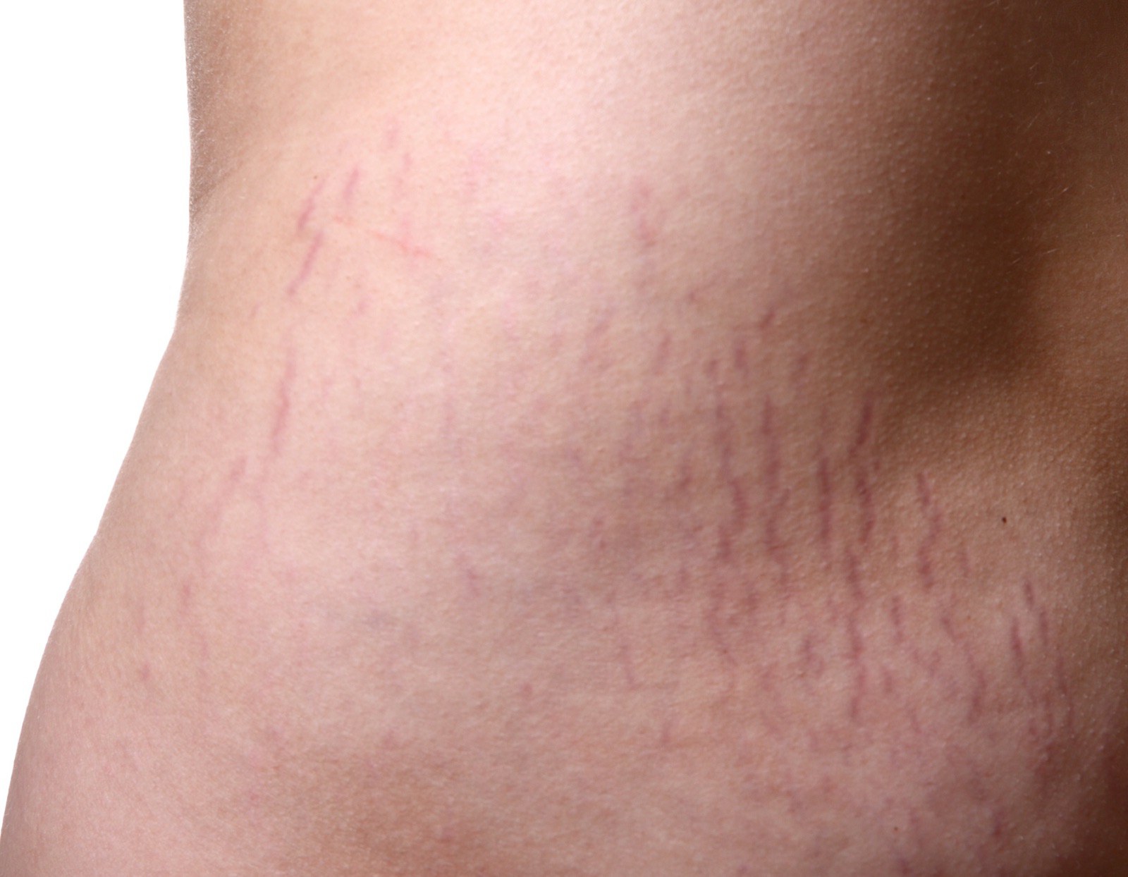 Stretch Marks