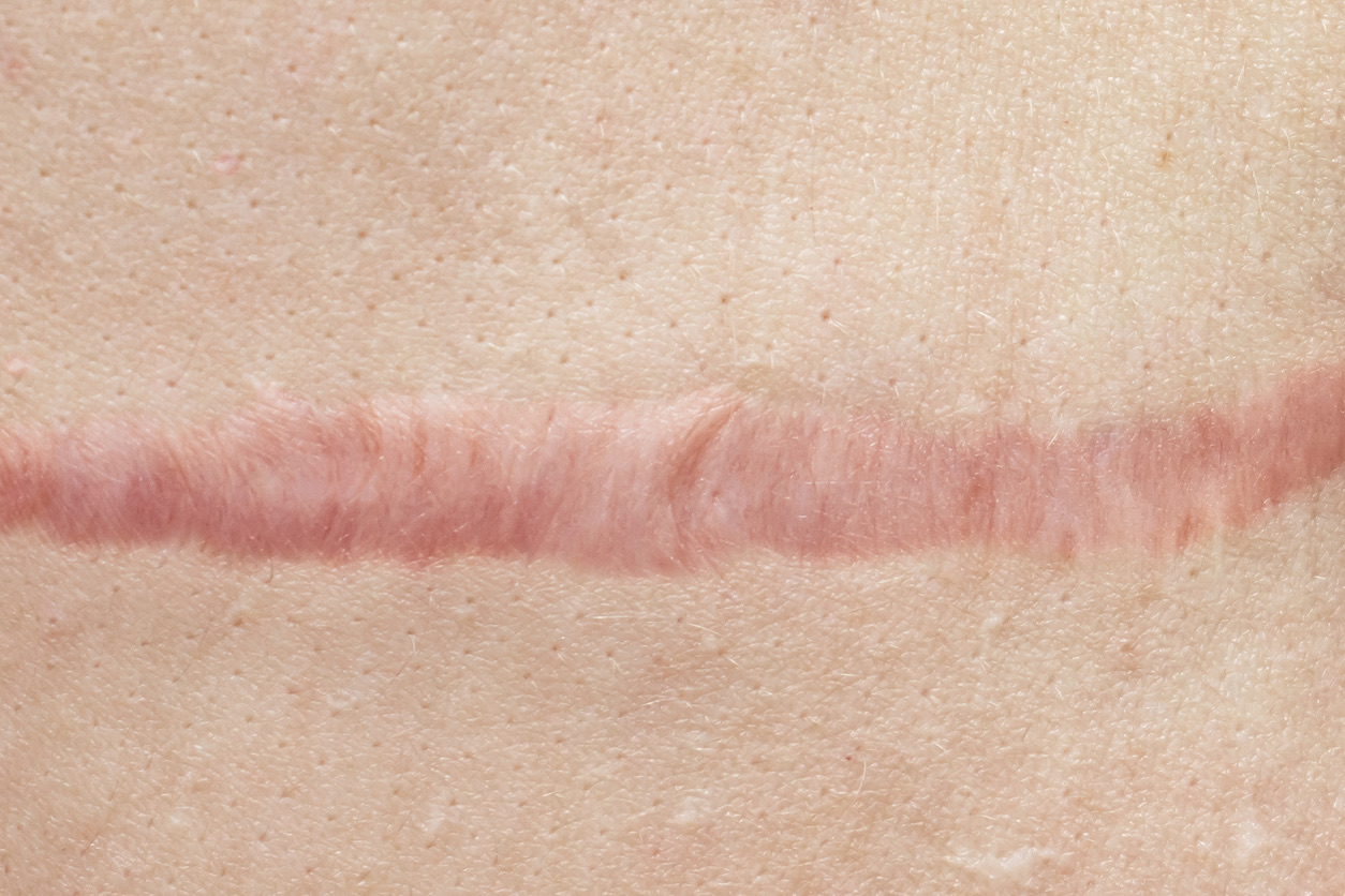 Surgical Scars