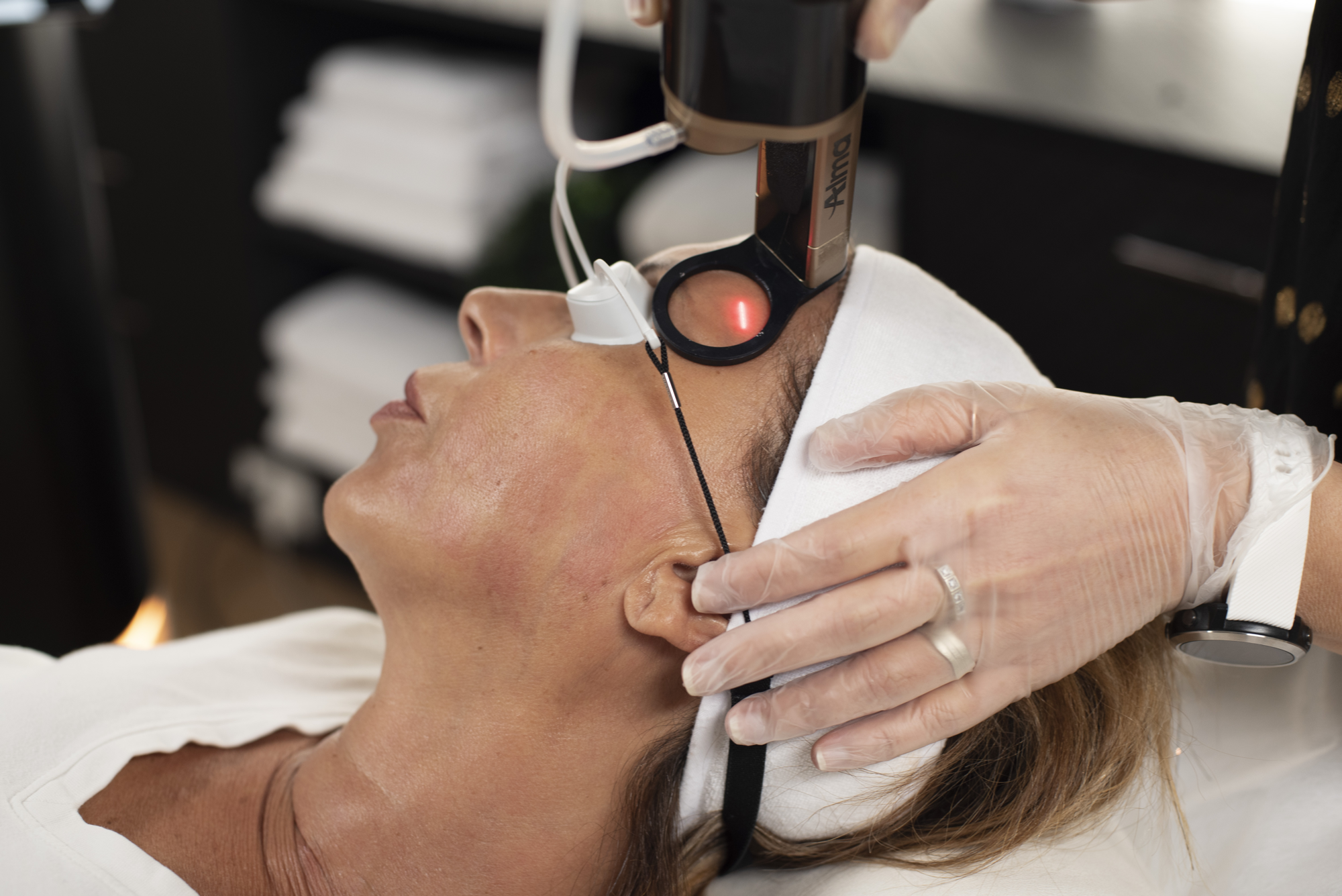 Alma Hybrid™ laser treatment in progress