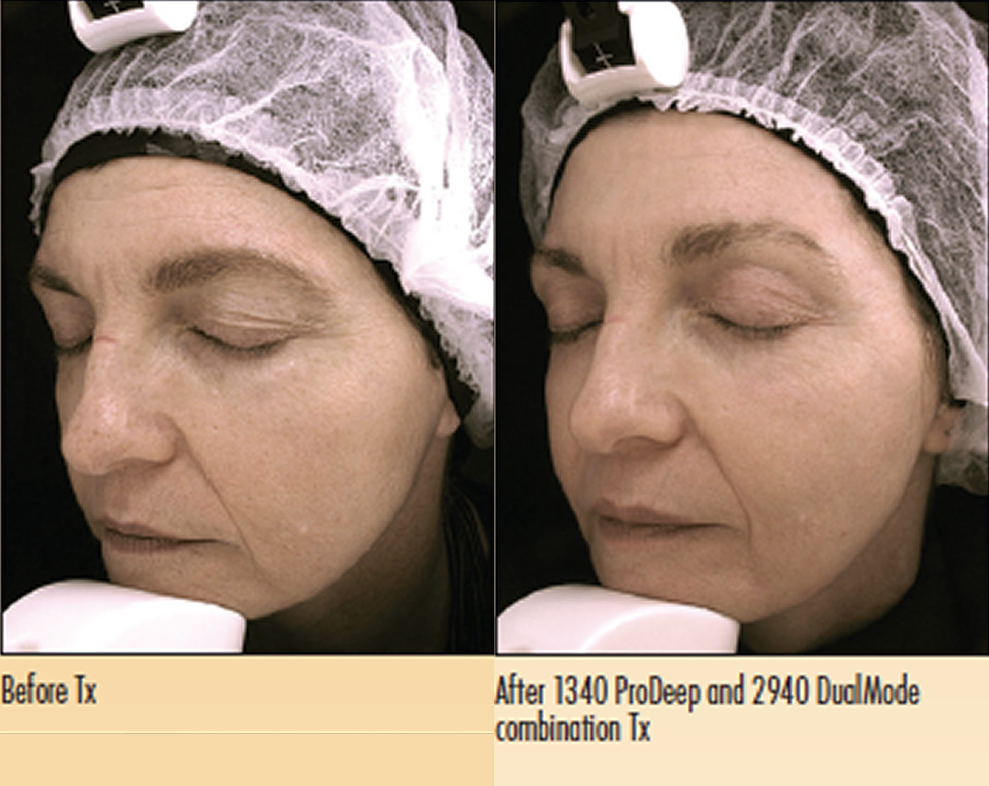 Etherea® ProDeep before and after, result 1