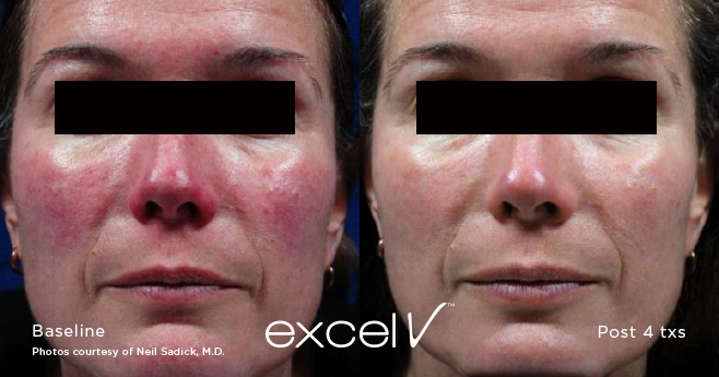 Excel® V+ before and after, result 1
