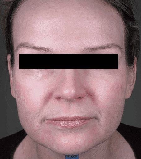 After Fraxel® Dual treatment
