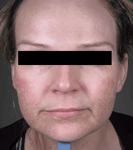Before Fraxel® Dual treatment