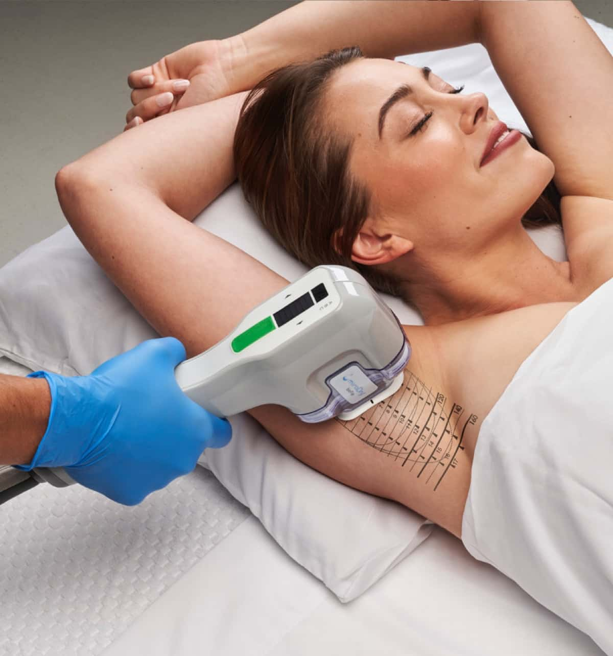 miraDry® treatment being performed on the underarm at Scars & Lasers