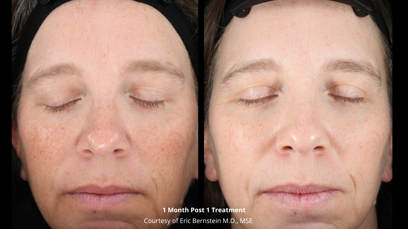 UltraClear® before and after, result 1