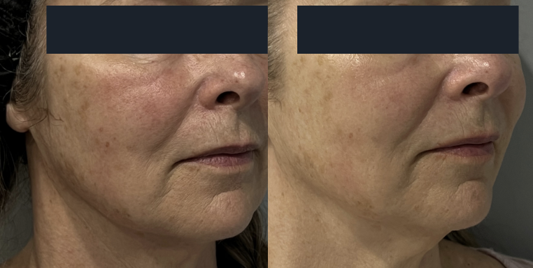Ultraformer MPT before and after, result 1