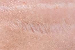 Atrophic Scar