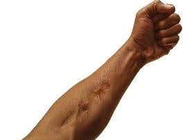 Burn Scar