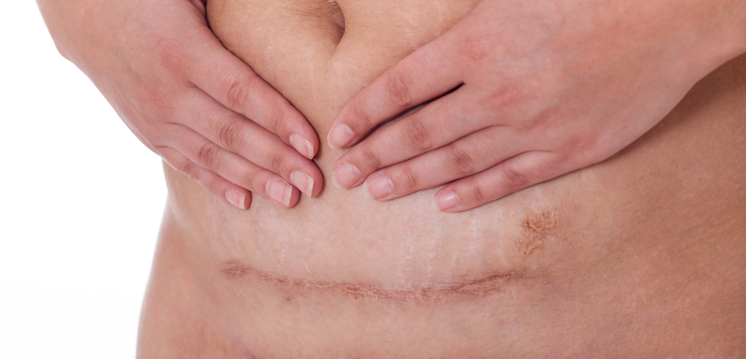 Cesarean Scar
