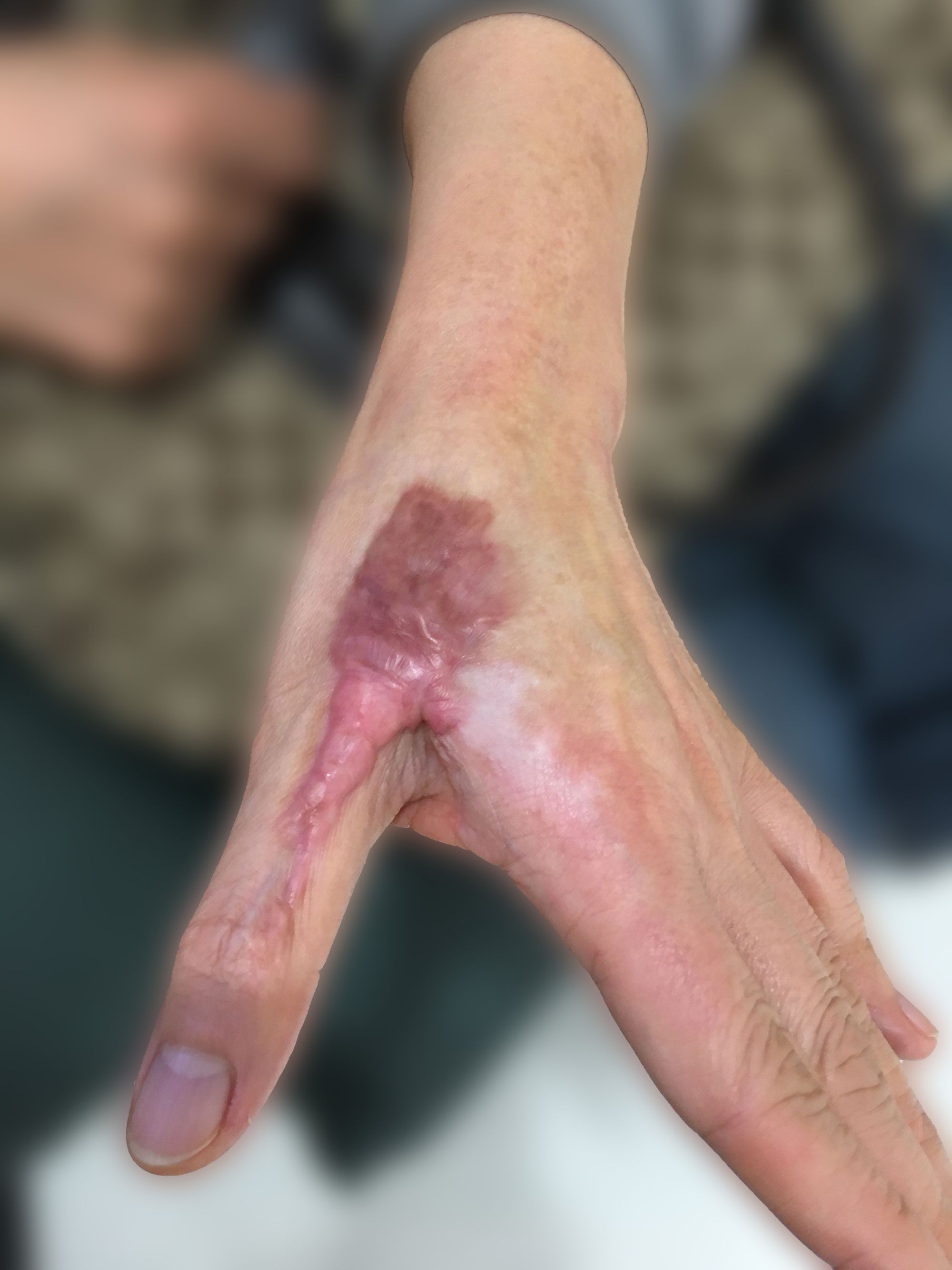 Contracture Scar