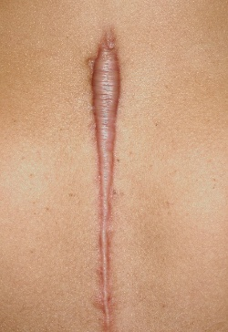 Hypertrophic Scar