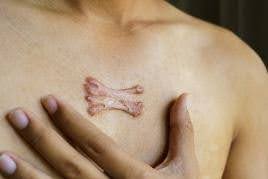 Keloid Scar