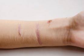 Self-harm Scars