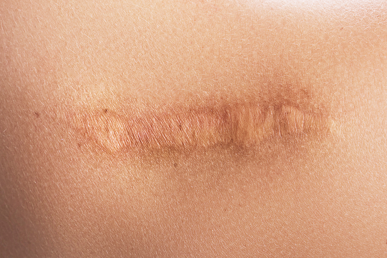 Stretched Flat Scar