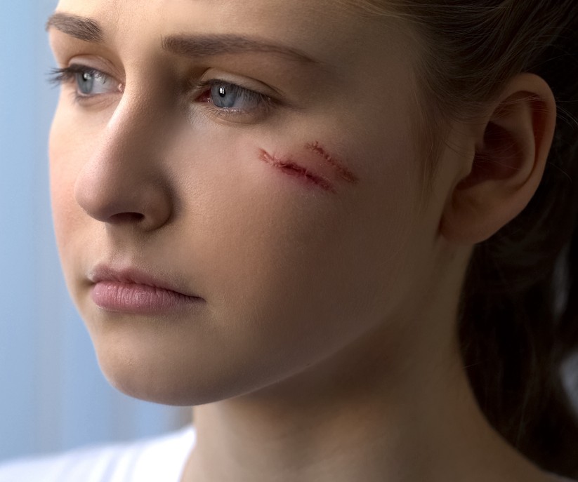 Wound Scars