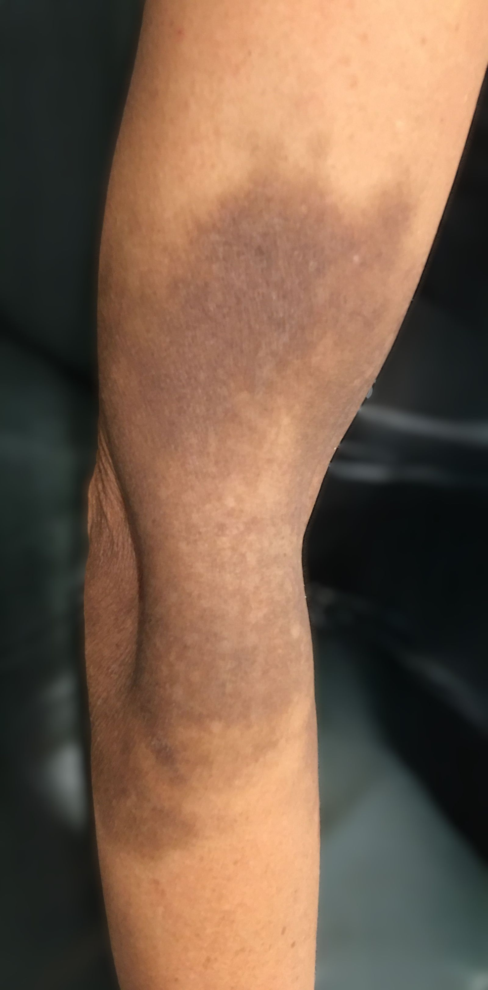 Iron Infusion Stain Removal