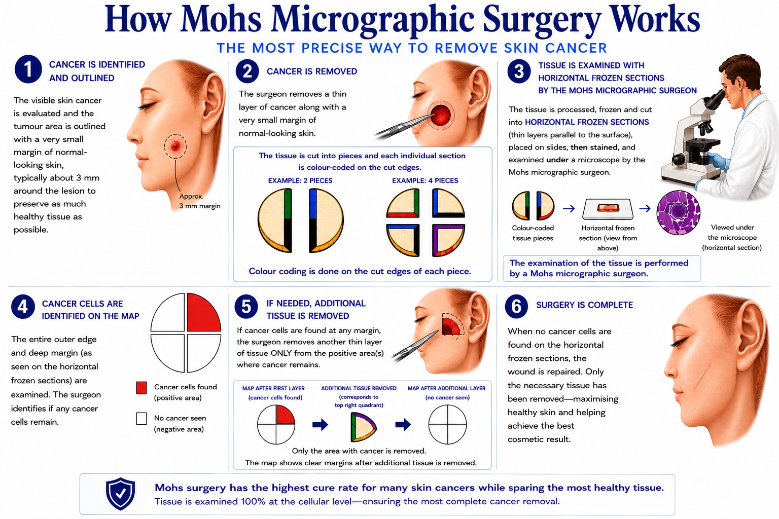 How Mohs micrographic surgery works: 1) the cancer is identified and outlined with a small margin; 2) a thin layer is removed and colour-coded; 3) tissue is examined with horizontal frozen sections under a microscope; 4) any remaining cancer cells are mapped; 5) additional tissue is removed only where cancer remains; 6) surgery is complete once margins are clear and the wound is repaired.