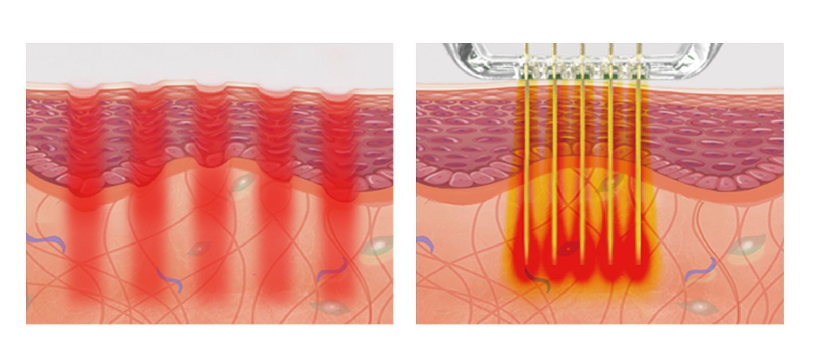 Microneedling micro-injury channels vs RF-energy delivery
